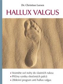 Hallux valgus